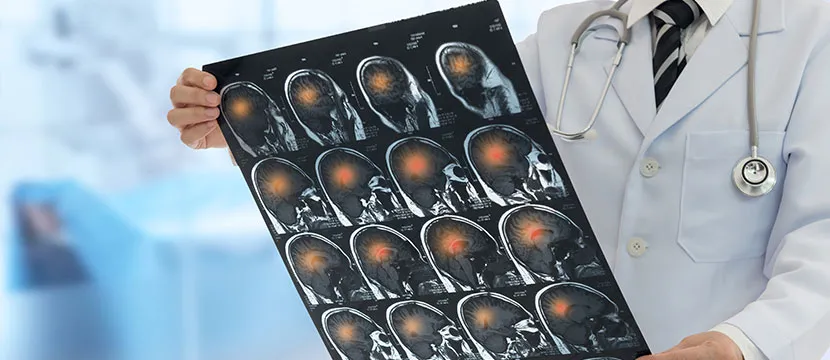 Chicago Traumatic Brain Injuries Lawyer-image